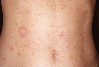 Comment traiter Pityriasis Rosea