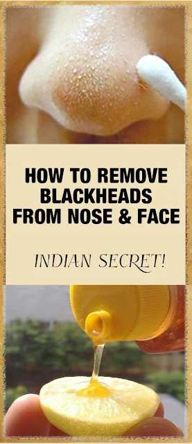 How To Remove Blackheads On Nose: Secret Indian Recipe!