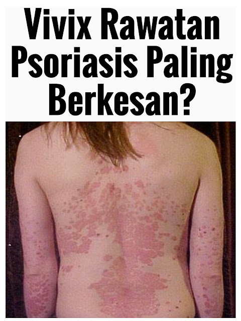 rawatan psoriasis, ubat psoriasis, cara rawat psoriasis, supplements psoriasis, cure psoriasis, ubat psoriasis scalp, ubat psoriasis paling berkesan,