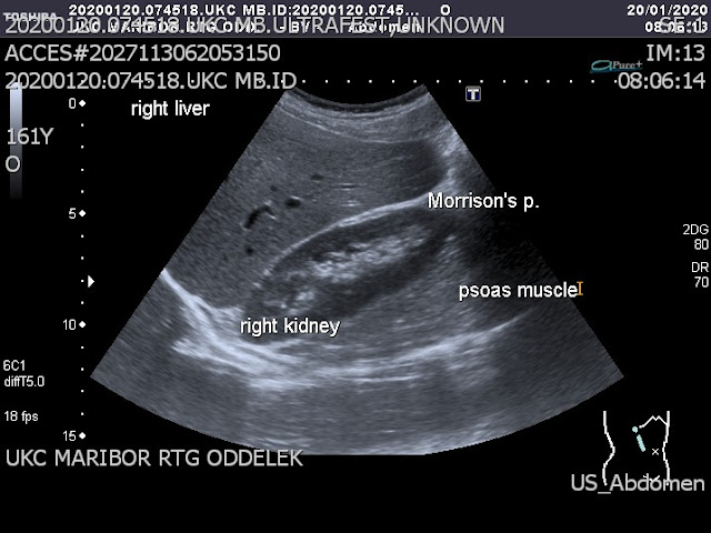 Ultrasound image of Morison's pouch