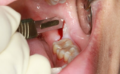 Cách khắc phục răng khôn bị chảy máu