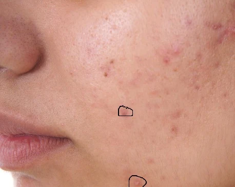 cystic acne, acne, acne treatment, acne skin care