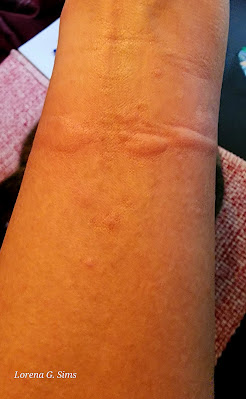 Itchy bumps, skin redness, allergic reaction to cold