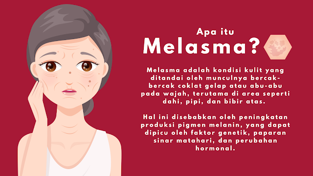 Apa itu Melasma dan bagaimana cara menghilangkan melasma