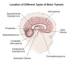 Pengobatan Penyakit Tumor Ganas