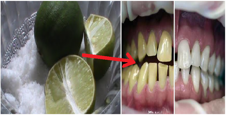 Cara Memutihkan Gigi Secara Alami dengan Jeruk Nipis dan 