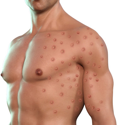 Monkeypox virus; History, Symptoms, causes, and treatment