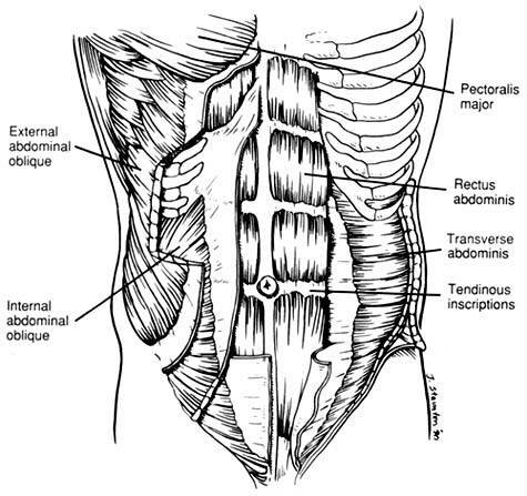 separated stomach muscles. separated abdominal muscle