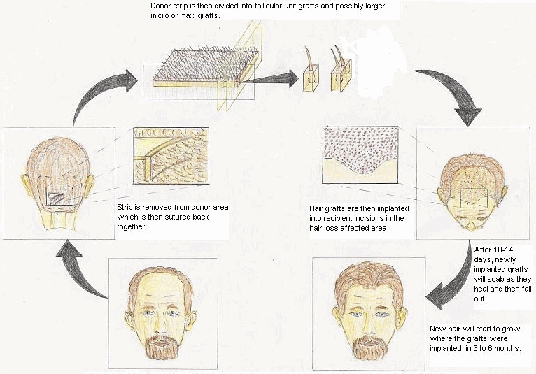 Hair Transplant Procedure