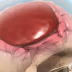 Hematoma subdural: qué es?