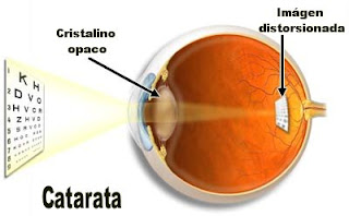 cirugia ojos catarata ocular