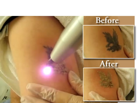 Widely considered the gold standard treatment modality to remove a tattoo 