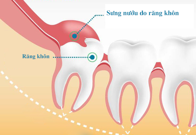 Lợi trùm răng khôn