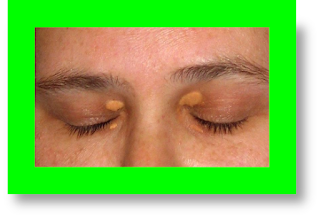 xanthelasma removal xanthelasma treatment xanthelasma eyelid xanthelasma around eyes xanthelasma associated with xanthelasma and heart disease xanthelasma and hypothyroidism what is the treatment for xanthelasma xanthelasma causes xanthelasma differential diagnosis xanthelasma eyelid images xanthelasma histology xanthelasma hypothyroidism xanthelasma images