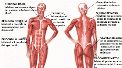 diferencias trigger points y puntos fibromialgia