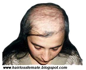 Hair Thinning Women on To Prevent Further Thinning Of Hair  I Got A Couple Of Tricks To Do It