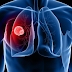 WHAT IS MESOTHELIOMA?