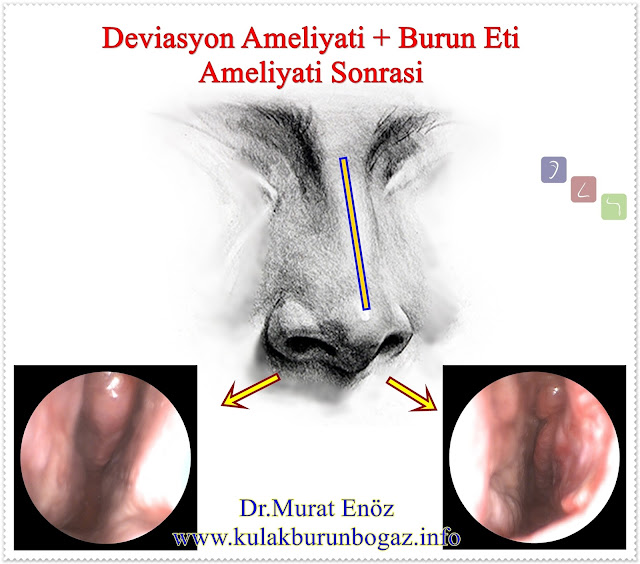 Septum deviasyonu - Burun kıkırdağı eğriliği - Nazal septum deviasyonu nasıl anlaşılır? - Deviasyon ameliyatı - Burun septumu eğriliği - Burun eğriliği