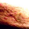 Causes Of Acne