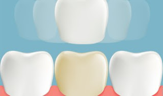 Răng thưa có nên làm răng sứ không ?