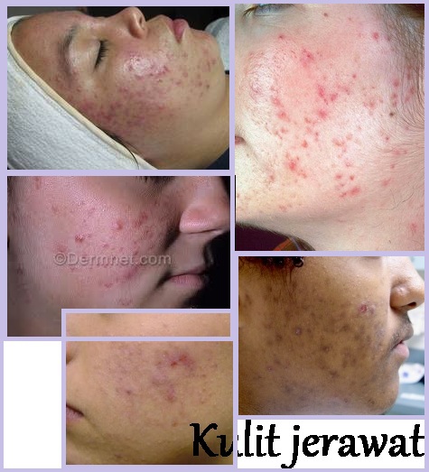 Kulit Jerawat – samyysandra.com