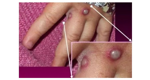 What is  monkeypox? What are the symptoms of monkeypox, what to do if you are infected or exposed?