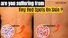 Symptoms Of Leukemia | Leukemia Tiny Red Spots On Skin | Chronic Myeloid Leukemia Symptoms | Chronic Myelogenous Leukemia Symptoms