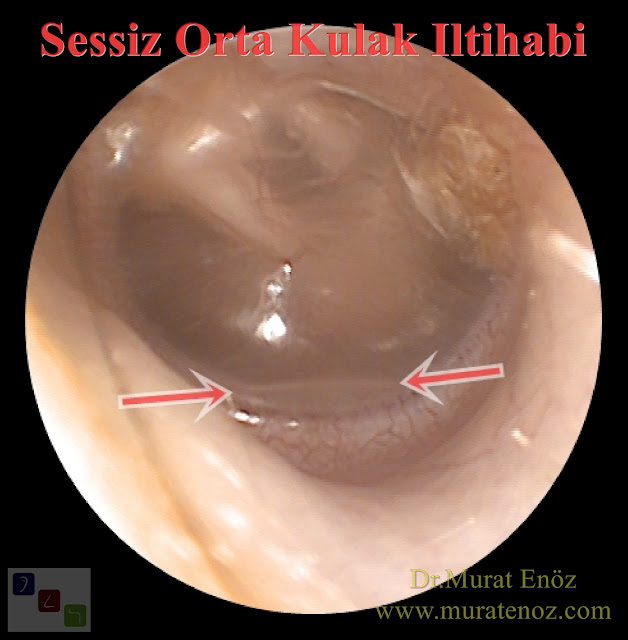 Sessiz orta kulak iltihabı tanımı - Sessiz orta kulak iltihabı terminoloji - Kronik sessiz orta kulak iltihabı - Sessiz orta kulak iltihabı nasıl ortaya çıkar? - Östaki tüpü ile ilgili sorunlar, orta kulak sıvılarında en sık neden olarak görülmektedir - Efüzyonlu otitis media mutlaka akut otitis mediayı takiben ortaya çıkmaz! - Yarık damak olan hastalarda, sessiz orta kulak iltihabı ortaya çıkabilir! - Sessiz orta kulak iltihabı için risk faktörleri - Düzeltilmiş yanlış bir ifade "orta kulak sıvısı dışarıdan kulağa sıvı kaçmasıyla ortaya çıkmaz" - Sessiz orta kulak iltihabı nasıl seyreder? - Sessiz orta kulak iltihabının belirtileri - Sessiz orta kulak iltihabının tanısı - Sessiz orta kulak iltihabı tedavisi - Çocuğunuzda sessiz orta kulak iltihabını nasıl önleyebilirsiniz? - Sessiz orta kulak iltihabı komplikasyonları - Maskeli orta kulak iltihabı - Effüzyonlu otitis media - Sekretuar otitis media - Seröz otitis media - Silent otitis media - Masked otitis media - Serous otitis media - Otitis media with effusion (OME)