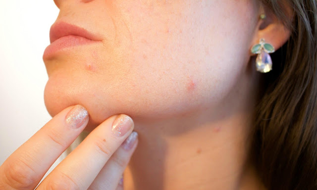B Vitamins and Acne Pimples