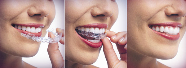 Niềng răng invisalign giúp rút ngắn thời gian điều trị