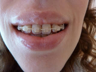 A photograph of teeth with fixed ceramic braces at week 17 of treatment