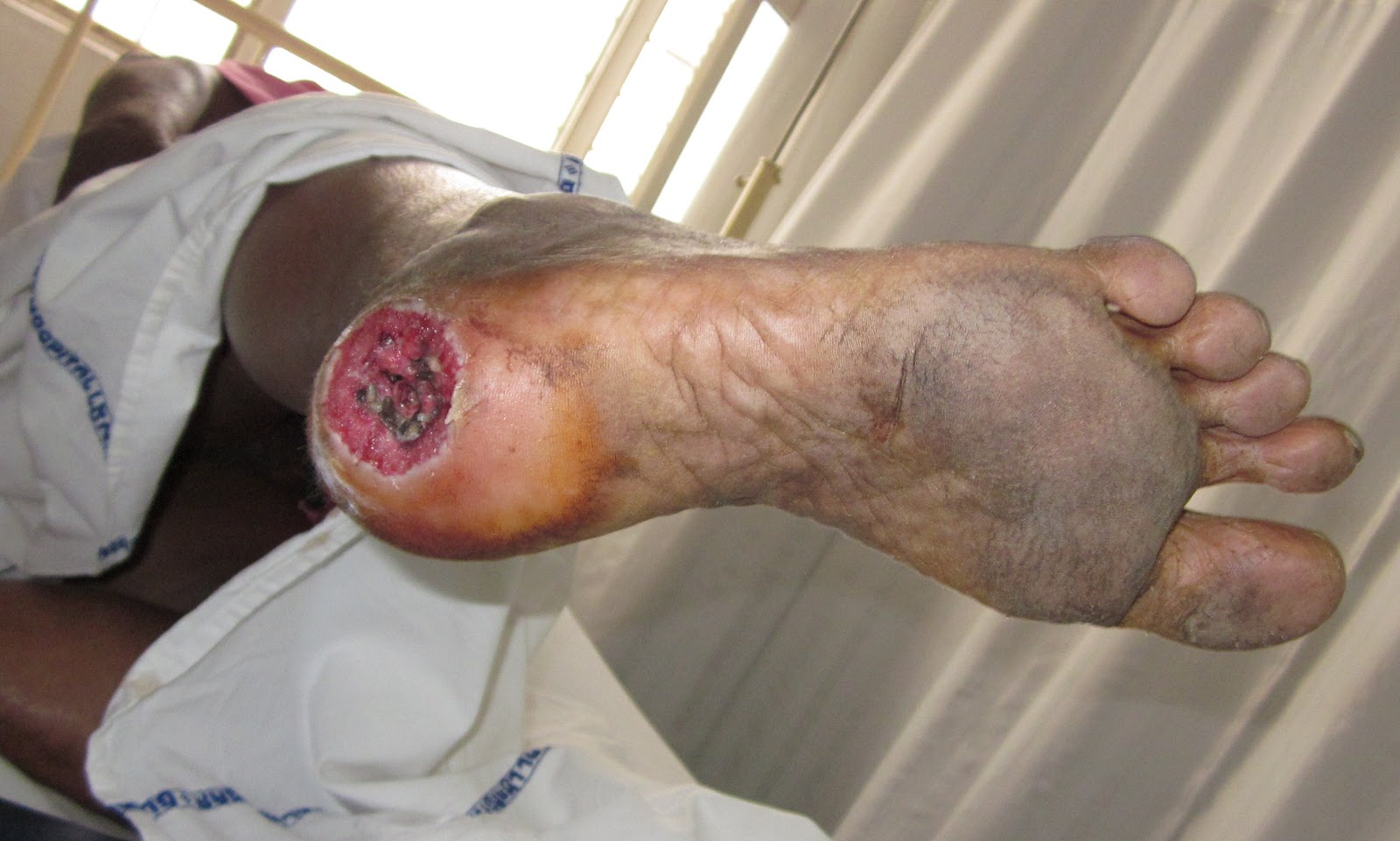 Diabetic Foot Infection With Maggots