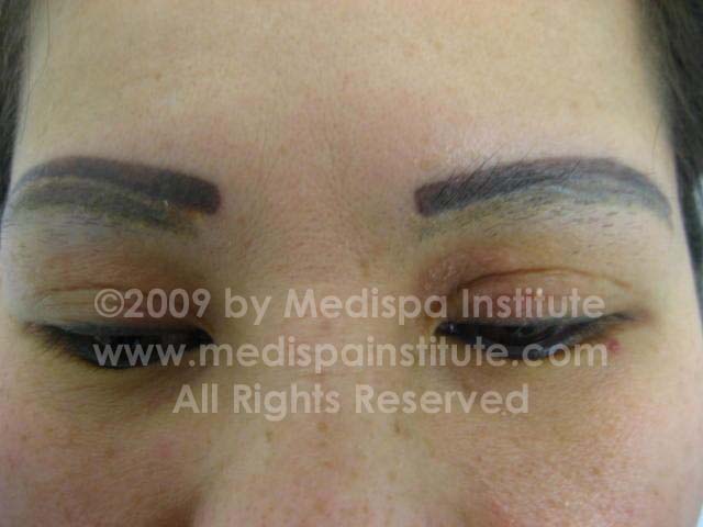 Eyebrows Tattoo Removal