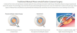 cataract surgery Singapore