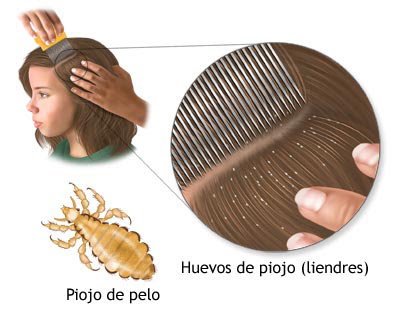 Tratamiento contra los piojos