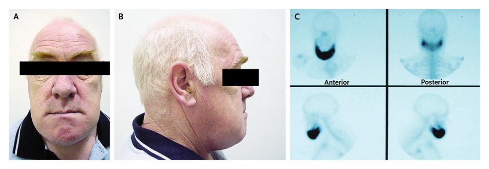 aneurysmal bone cyst jaw. of painful jaw enlargement