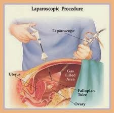 http://www.mannatfertility.com/Laparoscopic-Surgery.php