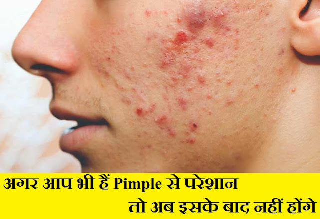 How to treat pimple