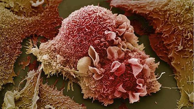 Foto mikroskop elektron sel kanker dari usus besar