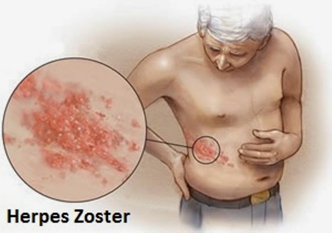 cara menyembuhkan herpes