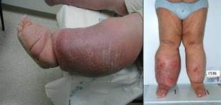 early stages of lymphedema