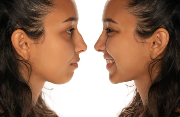 Types and Benefits of Rhinoplasty