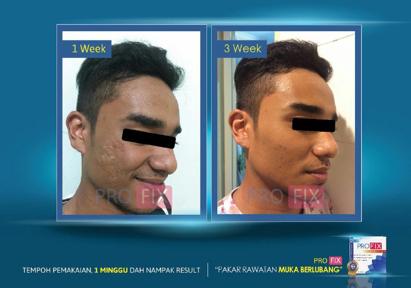 ProFix Vitamin Muka Berlubang: PROFIX- Krim Parut Jerawat 