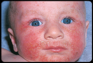 Baby Eczema