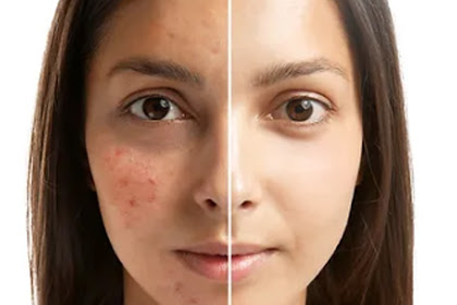 Treating Acne Scars: Effective Skincare Strategies