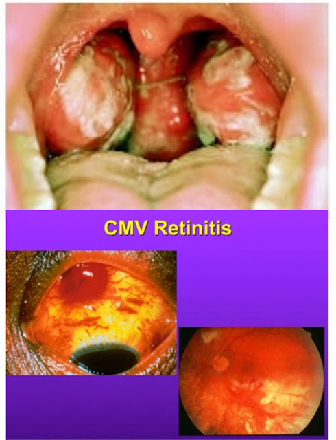 Herpes tipo 5. Síntomas normales de la enfermedad del beso, con inflamación de los ganglios linfáticos (A); Cuando se reactiva con un sistema inmude debilitado causa retinitis severa que puede llevar a la ceguera (B).