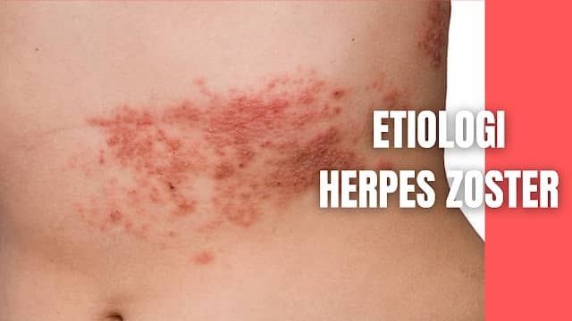 Etiologi Herpes Zoster Pada Manusia Varicella zoster virus (VZV) adalah virus yang menyebabkan cacar air (chicken pox) dan herpes zoster (shingles). VZV memiliki klasifikasi taksonomi sebagai berikut (Ann M, 1996) :  Kelas : Kelas I (dsDNA) Famili : Herpesviridae Upafamili : Alphaherpesvirinae Genus : Varicellovirus Spesies : Human herpes zoster Varicella zoster adalah virus yang hanya dapat hidup di manusia dan primata (simian). Pertikel virus (virion) varicella zoster memiliki ukuran 120-300 nm. Virus ini memiliki 69 daerah yang mengkodekan gen tertentu sedangkan genom virus ini berukuran 125 kb (kilo-basa). Komposisi virion adalah berupa kapsid, selubung virus, dan nukleokapsid yang berfungsi untuk melindungi inti berisi DNA double stranded genom. Nukleokapsid memiliki bentuk ikosahedral, memiliki diameter 100-110 nm, dan terdiri dari 162 protein yang dikenal dengan istilah kapsomer. Virus ini akan mengalami inaktivasi pada suhu 56-60 °C dan menjadi tidak berbahaya apabila bagian amplop virus ini rusak. Penyebaran virus ini dapat terjadi melalui pernapasan dan melalui vesikel pada kulit pada penderita (Manfred dkk., 1999).    Nah itu dia bahasan dari etiologi herpes zoster pada manusia, melalui bahasan di atas bisa diketahui mengenai etiologi herpes zoster pada manusia. Mungkin hanya itu yang bisa disampaikan di dalam artikel ini, mohon maaf bila terjadi kesalahan di dalam penulisan, dan terimakasih telah membaca artikel ini."God Bless and Protect Us"