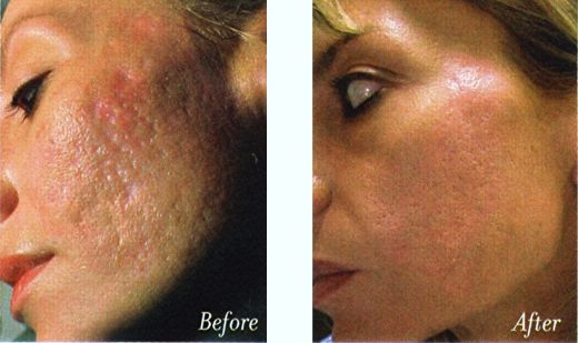 Type Of Acne: What Is Mederma Acne Scars