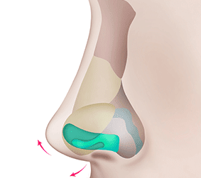 짱이뻐! - Korean Rhinoplasty - Arrowhead Nose Surgery