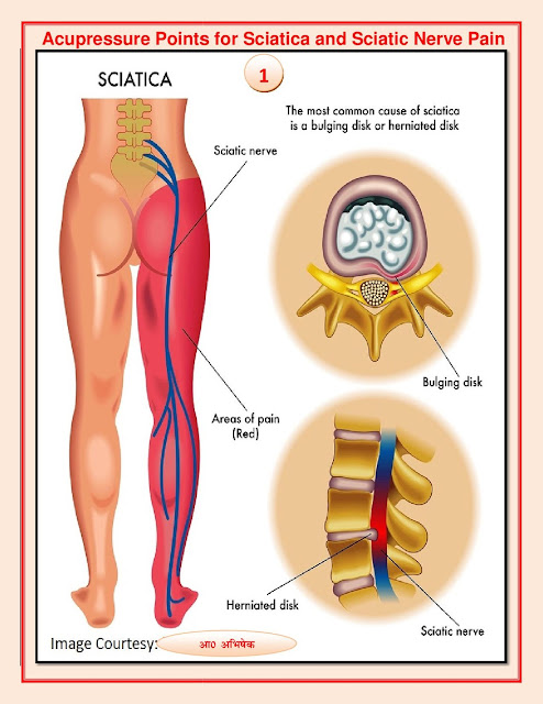 सियाटिका, सायटिका, साइटिका, कटिस्नायुशूल और नितम्ब तंत्रिका दर्द , सैक्रोइलाइटिस(नितंब और पीठ के निचले हिस्से में दर्द)(Sacroilitis)के लिए एक्यूप्रेशर बिंदु (Acupressure Point For Sciatica and Sciatic Nerve Pain)